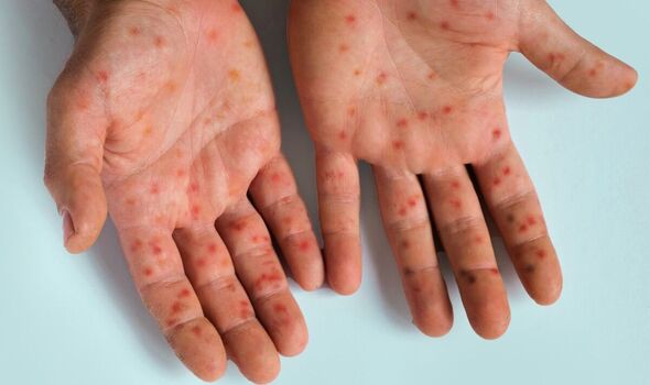 Monkey pox (मंकी पॉक्स) लक्षण और संचरण