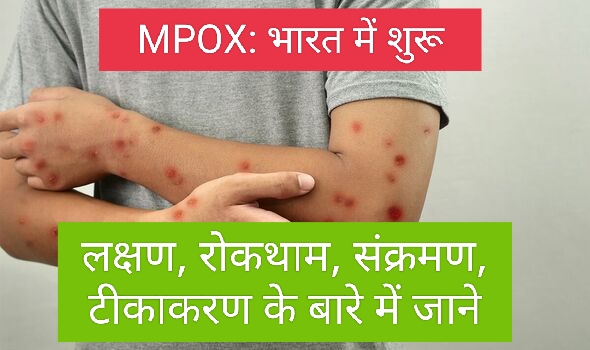 Mpox: भारत में एमपॉक्स का पहला संदिग्ध मामला सामने आया; लक्षण, रोकथाम, संक्रमण और टीकाकरण